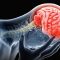Why Brain Injury Cases are More Complicated